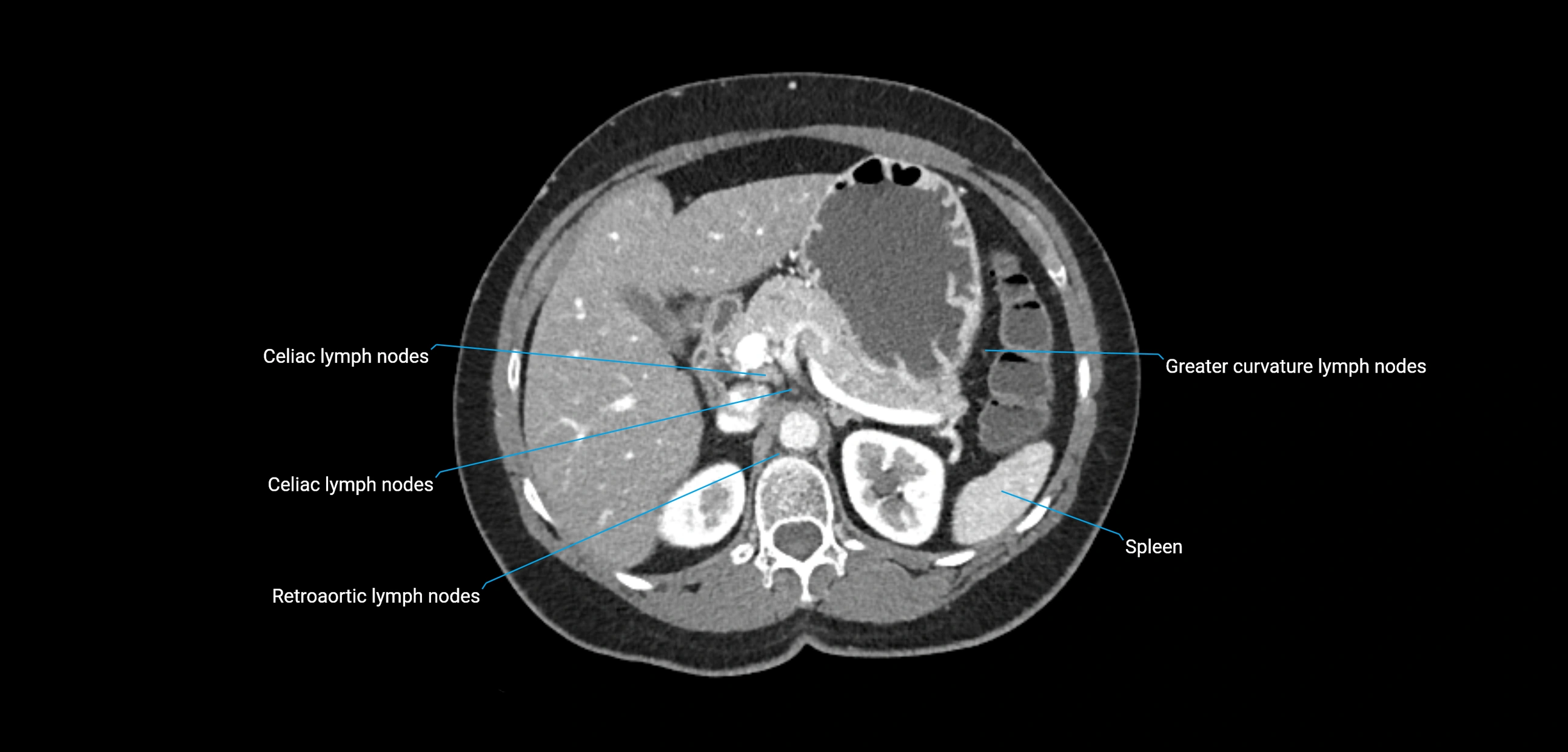 CT ct abdominal lymph nodes  axial cross sectional anatomy  enchanced radiology image -img-00002-00145.webp